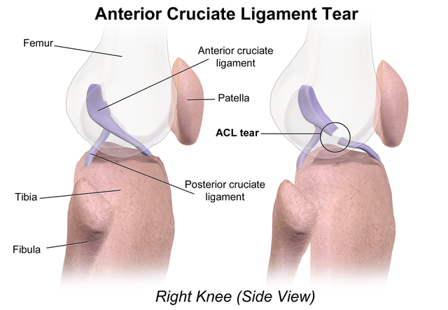 ACL Injuries 